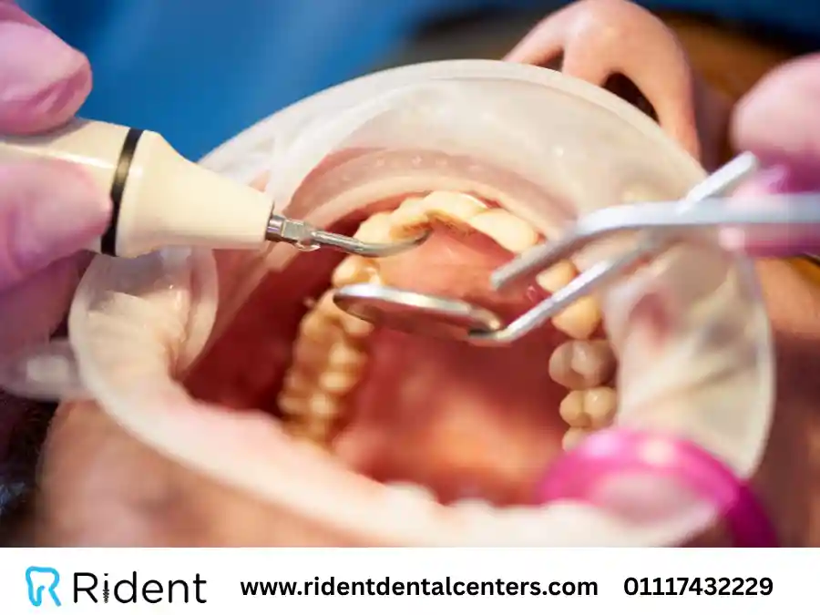 علاج التهاب الأسنان